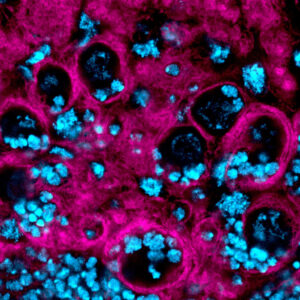 An optical section of a <i>Drosophila melanogaster</i> larval brain where a glioblastoma has been induced to study the cellular and molecular characteristics of the tumour