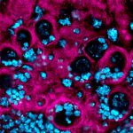 An optical section of a <i>Drosophila melanogaster</i> larval brain where a glioblastoma has been induced to study the cellular and molecular characteristics of the tumour